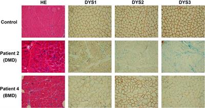 Novel Intronic Mutations Introduce Pseudoexons in DMD That Cause Muscular Dystrophy in Patients